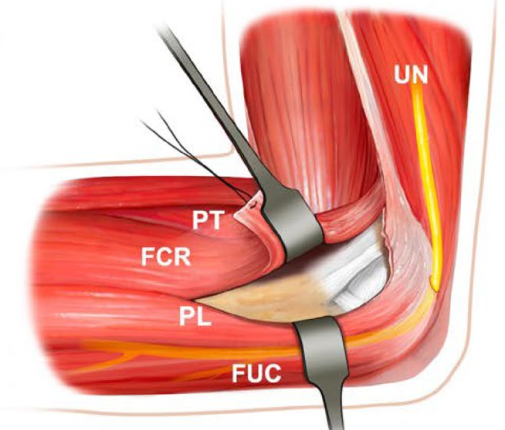 冠突骨折的解剖特点、分型与6种内侧手术入路