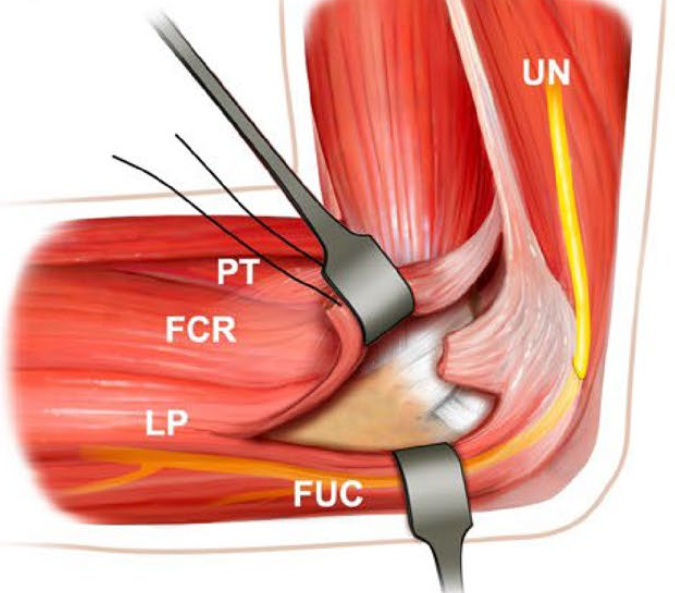 冠突骨折的解剖特点、分型与6种内侧手术入路