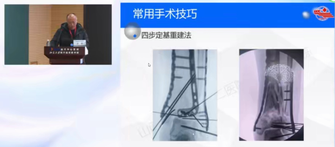 标准化流程，做Pilon骨折原来这么简单。