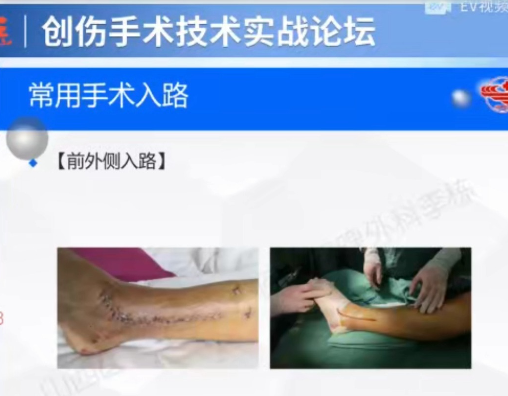 标准化流程，做Pilon骨折原来这么简单。