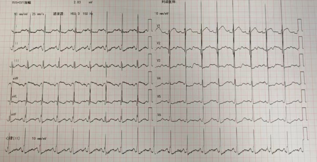 ​ST段的压低，不一定代表心脏缺血