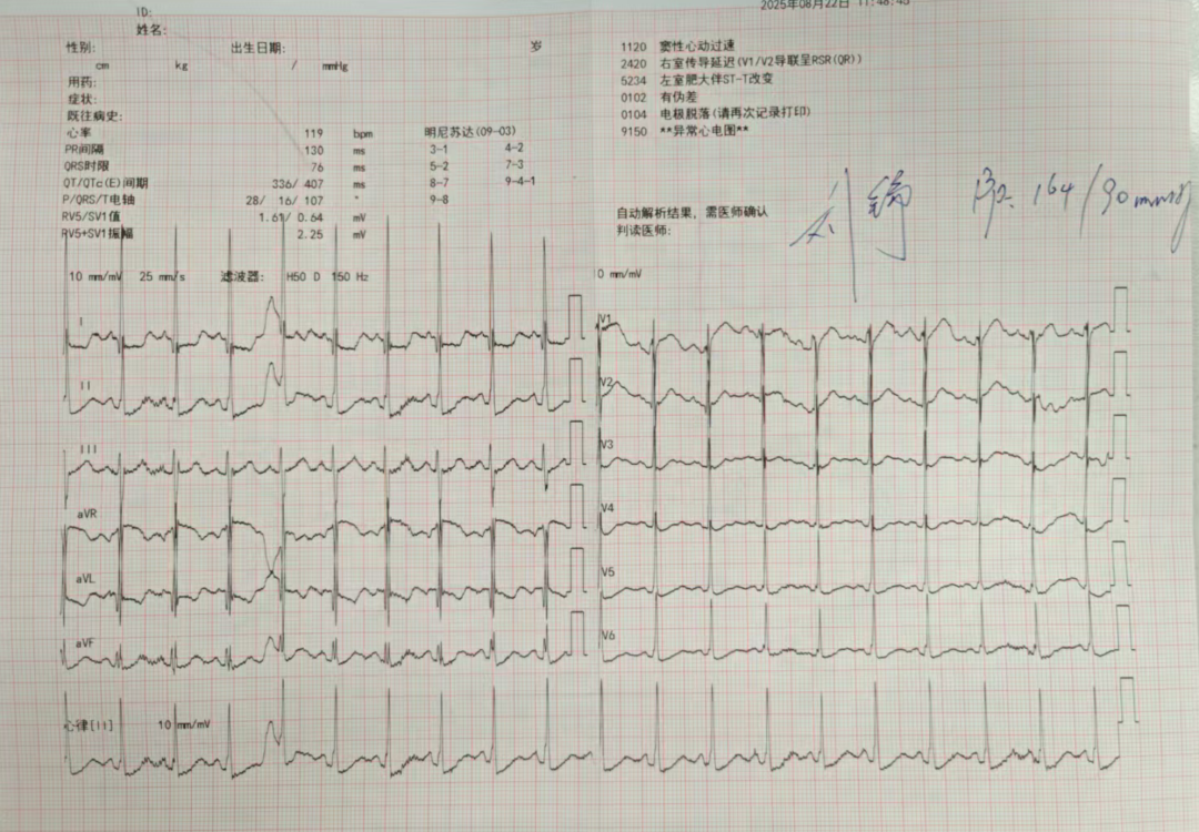 ​ST段的压低，不一定代表心脏缺血