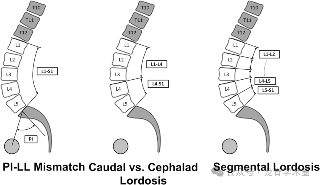 ​《JBJS》：腰椎退行性疾病中的矢状位平衡