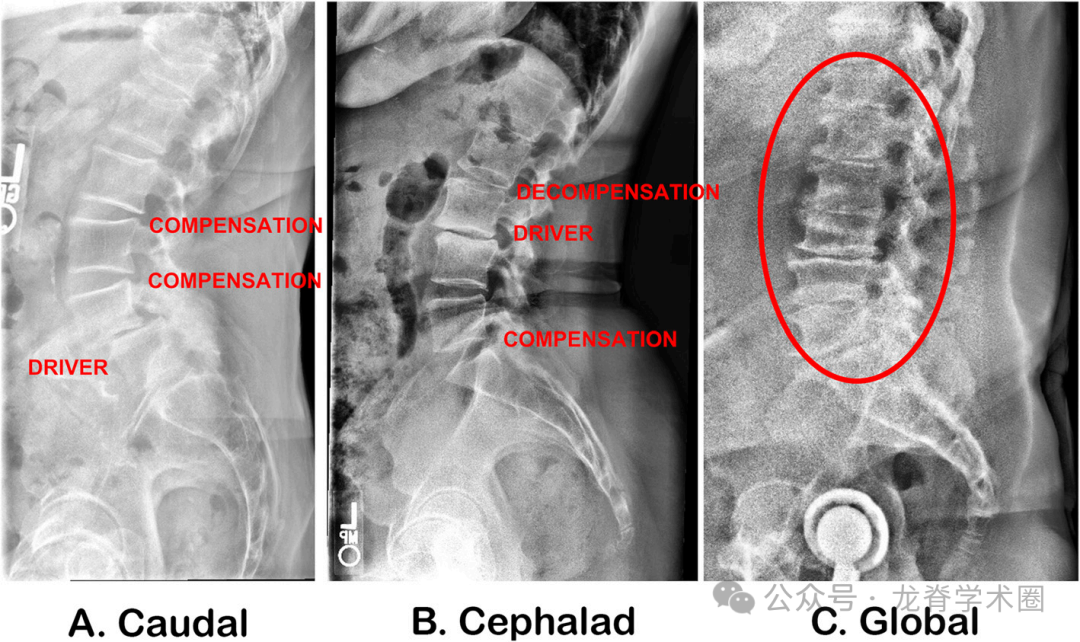​《JBJS》：腰椎退行性疾病中的矢状位平衡