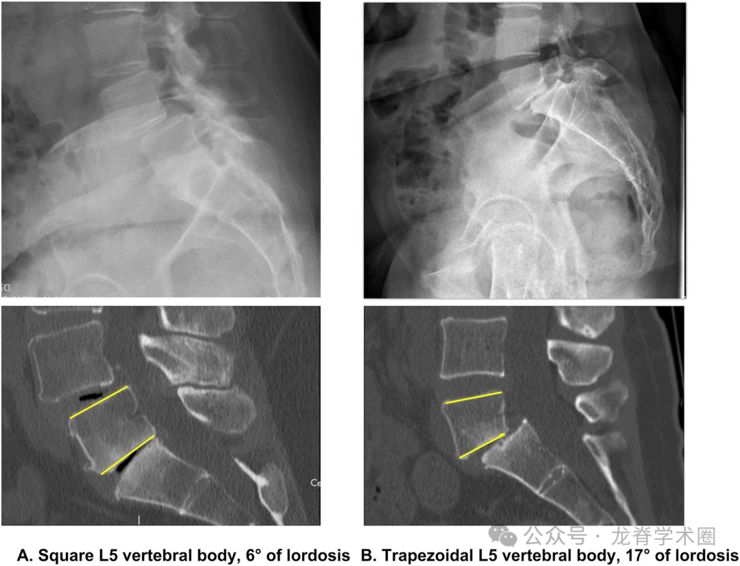 ​《JBJS》：腰椎退行性疾病中的矢状位平衡