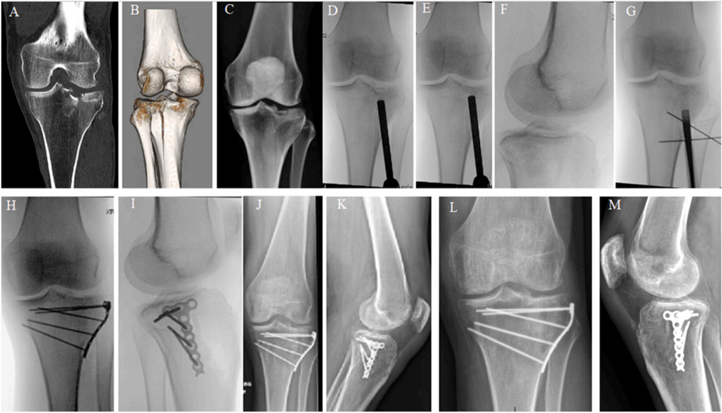 使用微型钢板对简单和复杂胫骨平台骨折进行碎片特异性固定