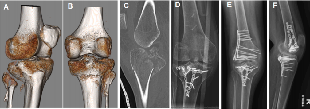 使用微型钢板对简单和复杂胫骨平台骨折进行碎片特异性固定