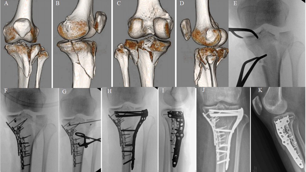 使用微型钢板对简单和复杂胫骨平台骨折进行碎片特异性固定