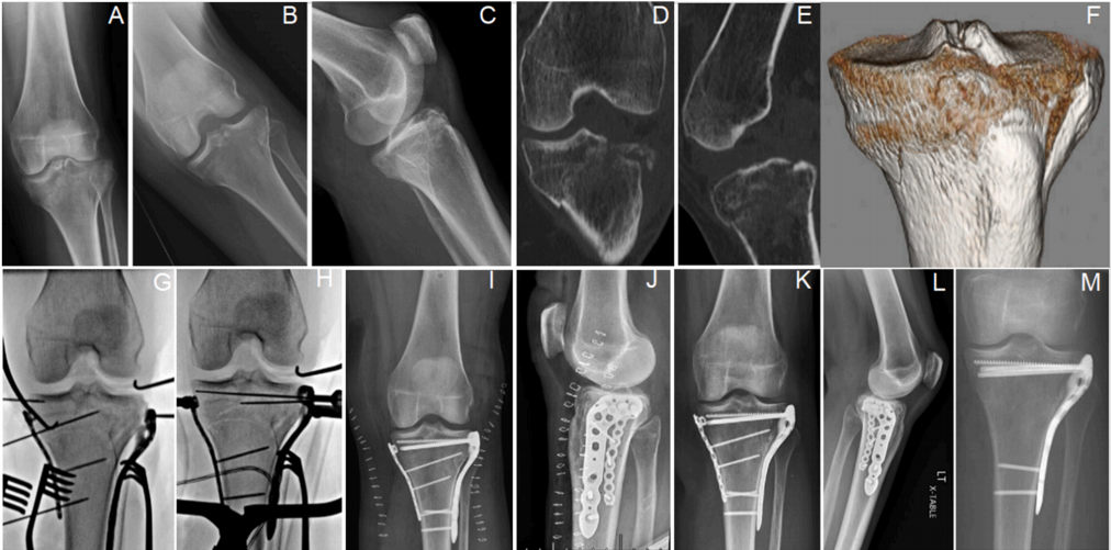 使用微型钢板对简单和复杂胫骨平台骨折进行碎片特异性固定