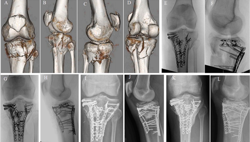 使用微型钢板对简单和复杂胫骨平台骨折进行碎片特异性固定