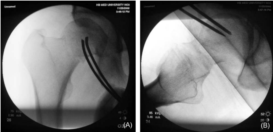 微创操纵杆技术（Joystick）在难复性股骨颈骨折复位中的应用