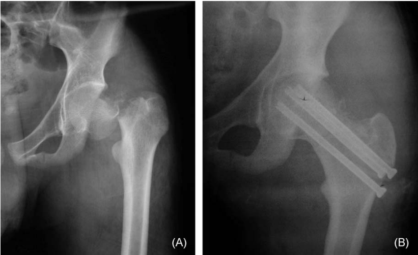 微创操纵杆技术（Joystick）在难复性股骨颈骨折复位中的应用