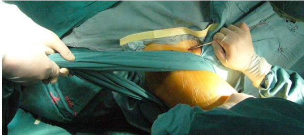 微创操纵杆技术（Joystick）在难复性股骨颈骨折复位中的应用