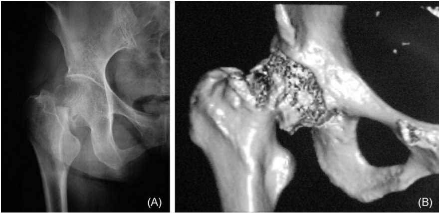 微创操纵杆技术（Joystick）在难复性股骨颈骨折复位中的应用