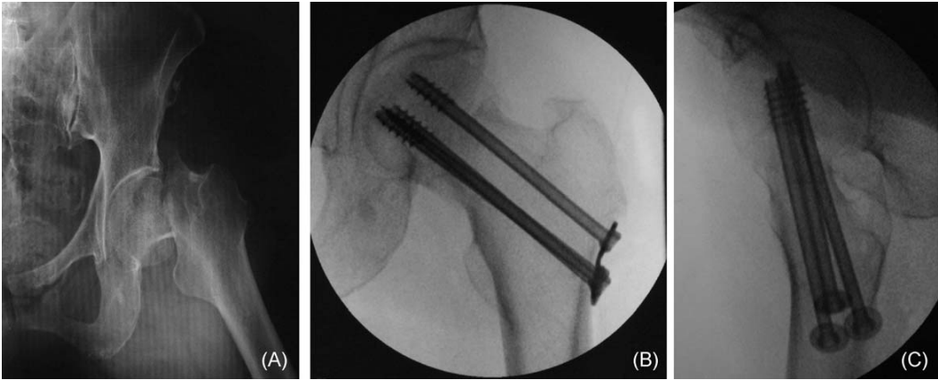 微创操纵杆技术（Joystick）在难复性股骨颈骨折复位中的应用