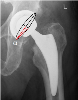 骨科医师必备技能：精准解读全髋置换术后X线片