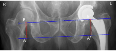 骨科医师必备技能：精准解读全髋置换术后X线片