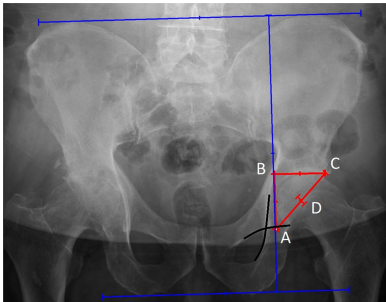 骨科医师必备技能：精准解读全髋置换术后X线片