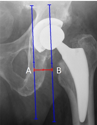骨科医师必备技能：精准解读全髋置换术后X线片
