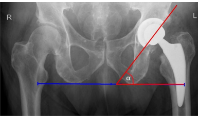 骨科医师必备技能：精准解读全髋置换术后X线片