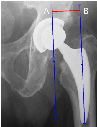 骨科医师必备技能：精准解读全髋置换术后X线片