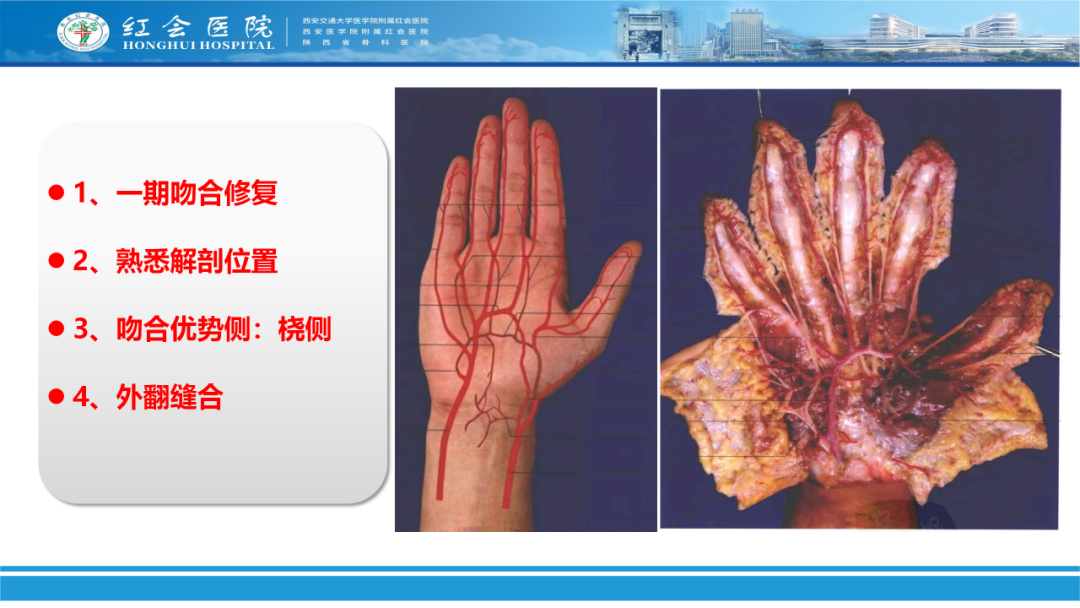 骨科实战：手外伤急诊处理原则精要