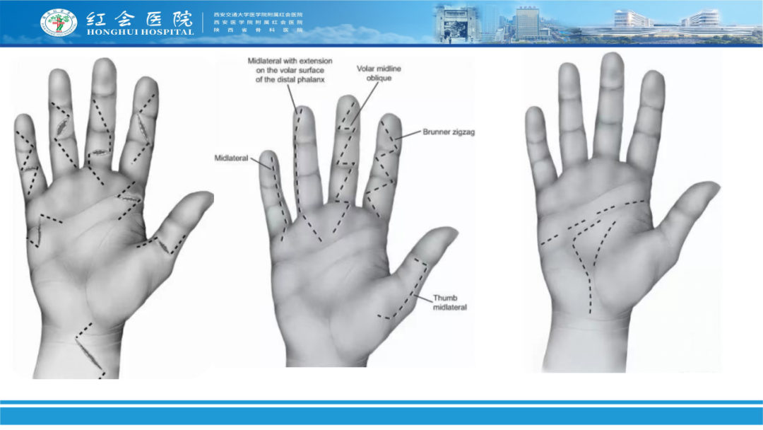 骨科实战：手外伤急诊处理原则精要