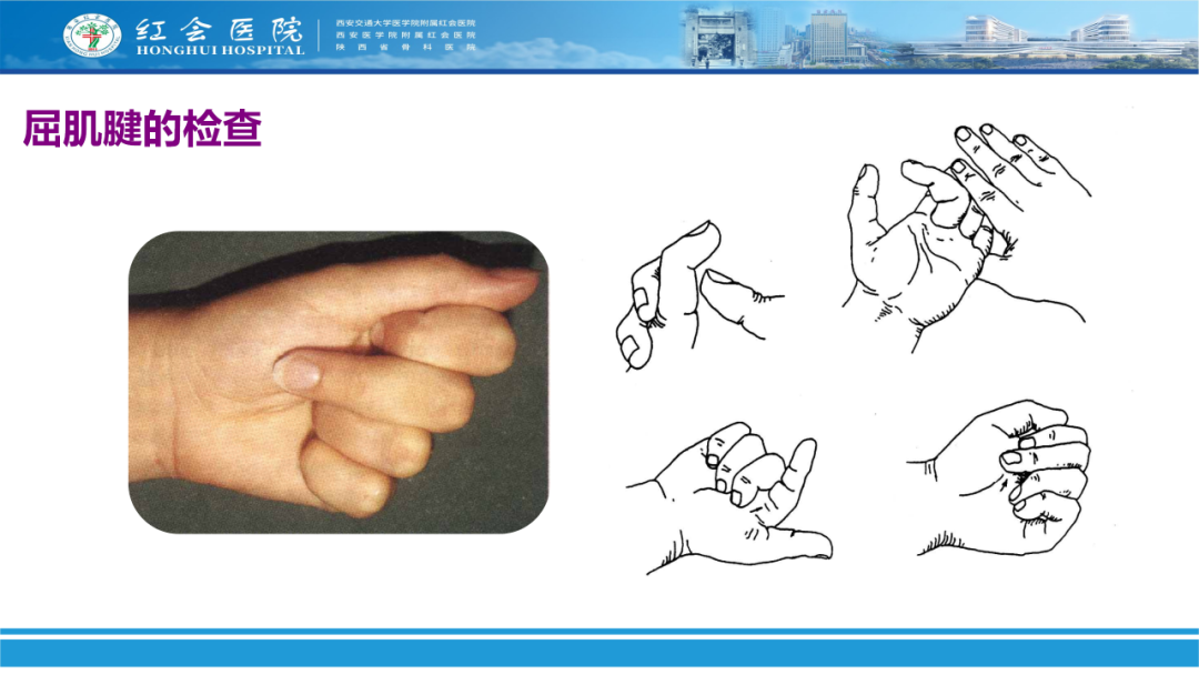 骨科实战：手外伤急诊处理原则精要