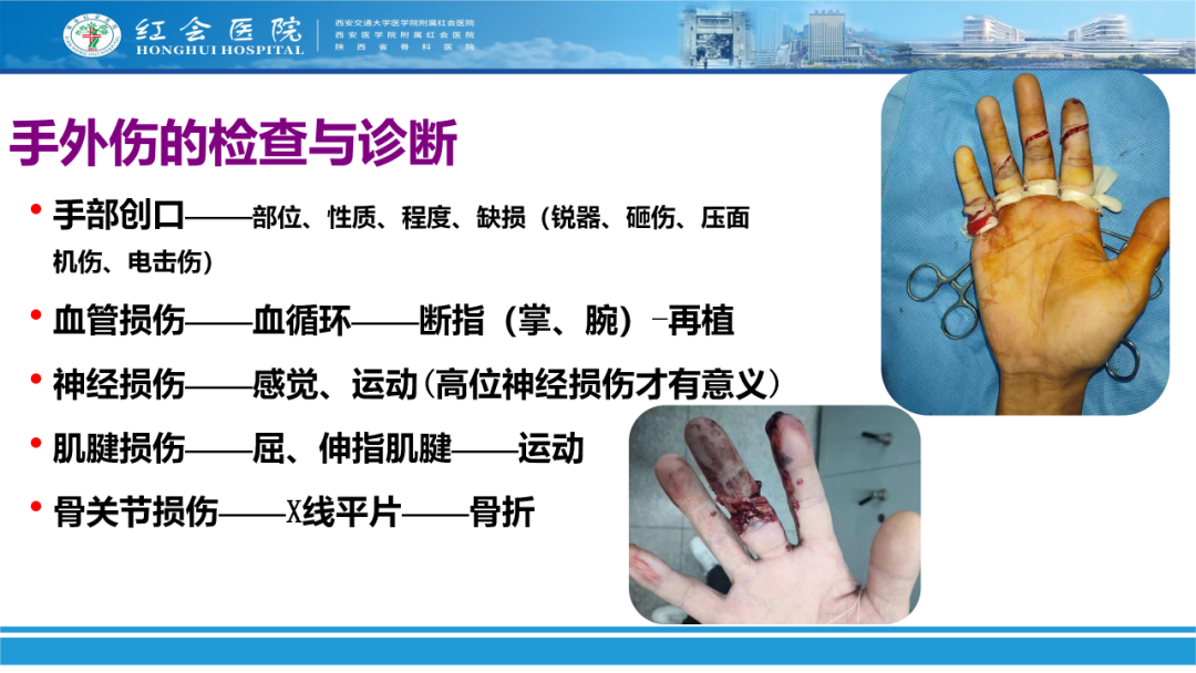 骨科实战：手外伤急诊处理原则精要