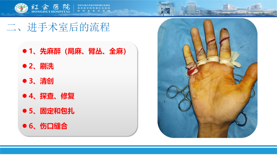 骨科实战：手外伤急诊处理原则精要