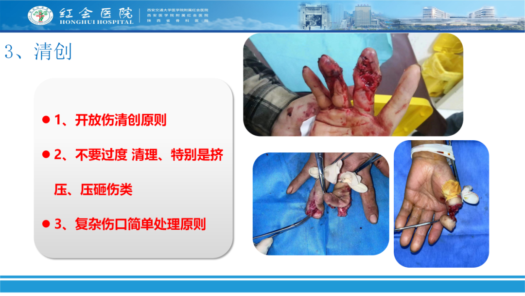 骨科实战：手外伤急诊处理原则精要