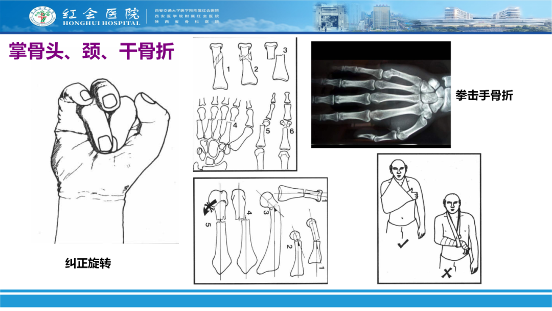 骨科实战：手外伤急诊处理原则精要