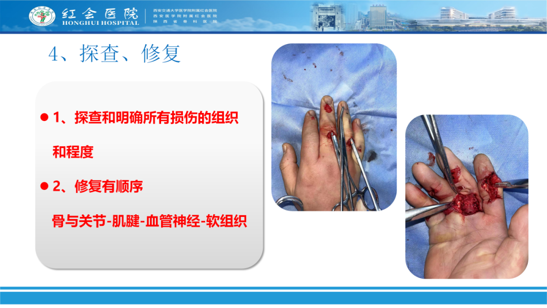 骨科实战：手外伤急诊处理原则精要