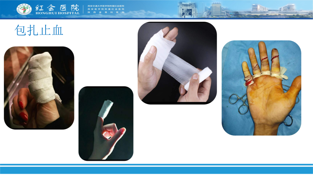 骨科实战：手外伤急诊处理原则精要