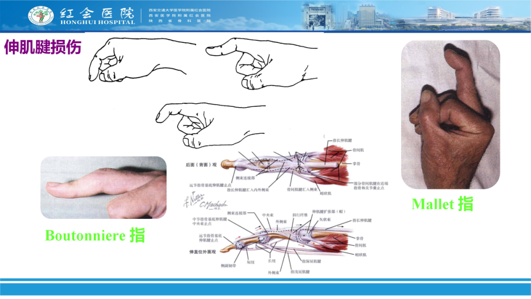 骨科实战：手外伤急诊处理原则精要