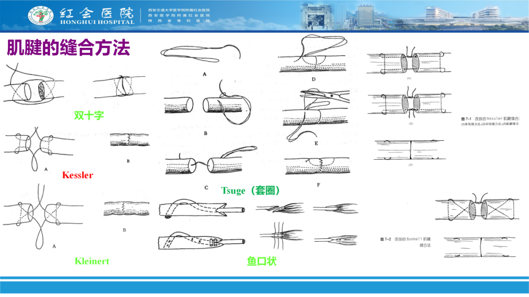 骨科实战：手外伤急诊处理原则精要