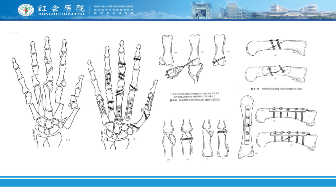 骨科实战：手外伤急诊处理原则精要