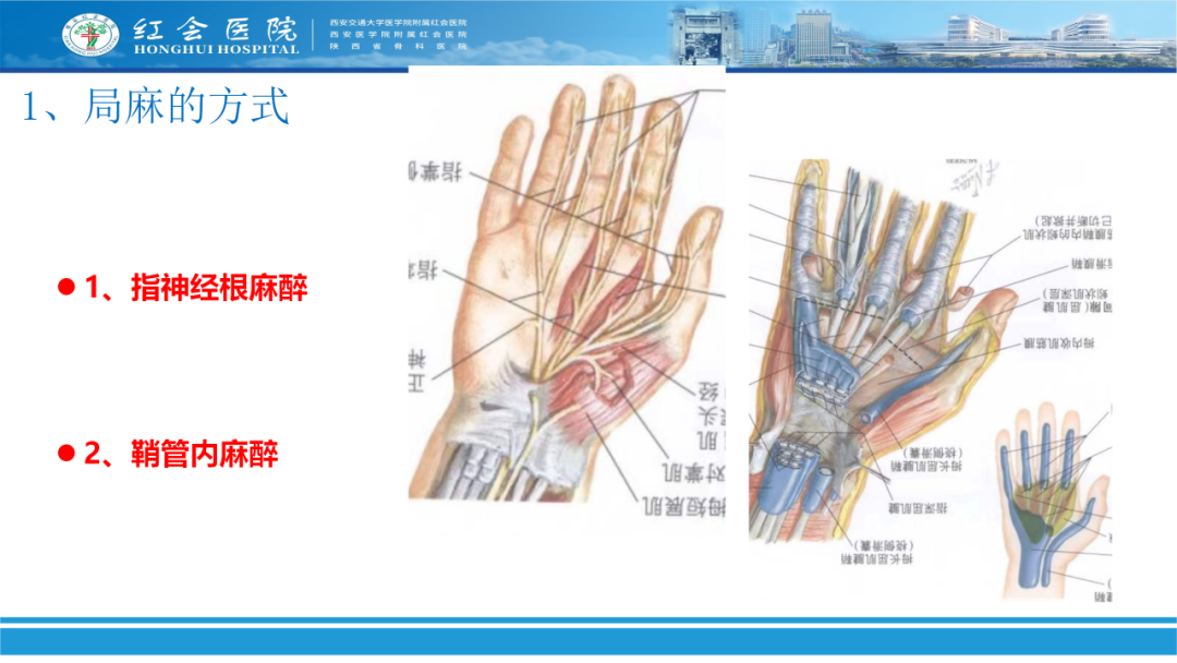 骨科实战：手外伤急诊处理原则精要