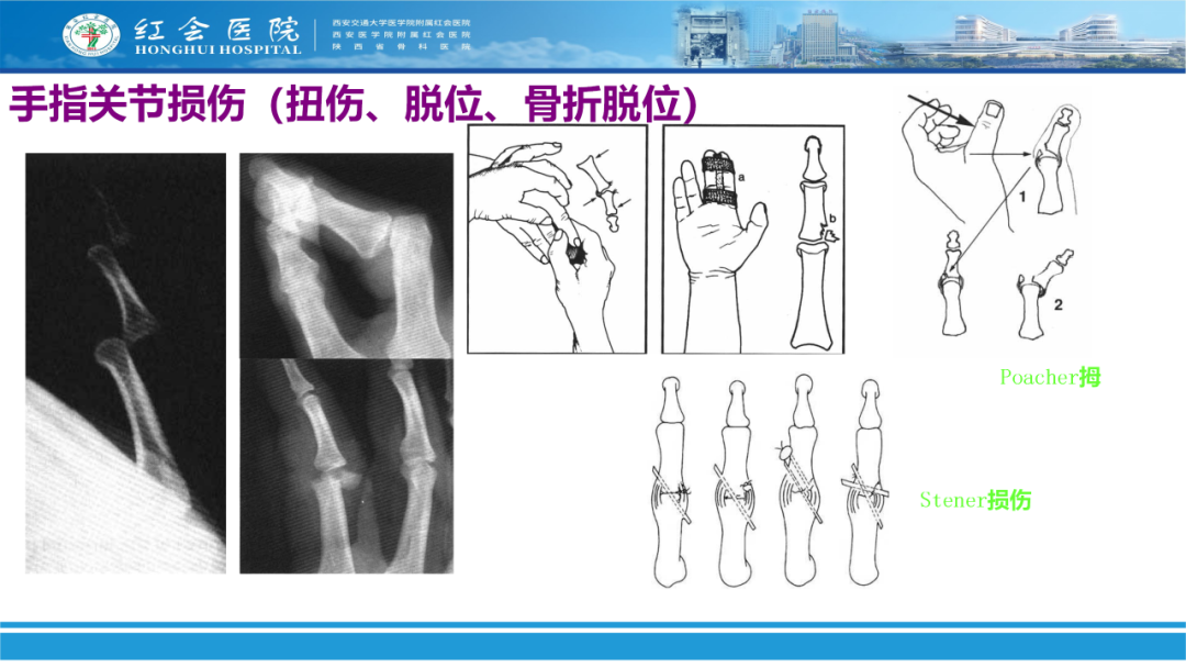 骨科实战：手外伤急诊处理原则精要