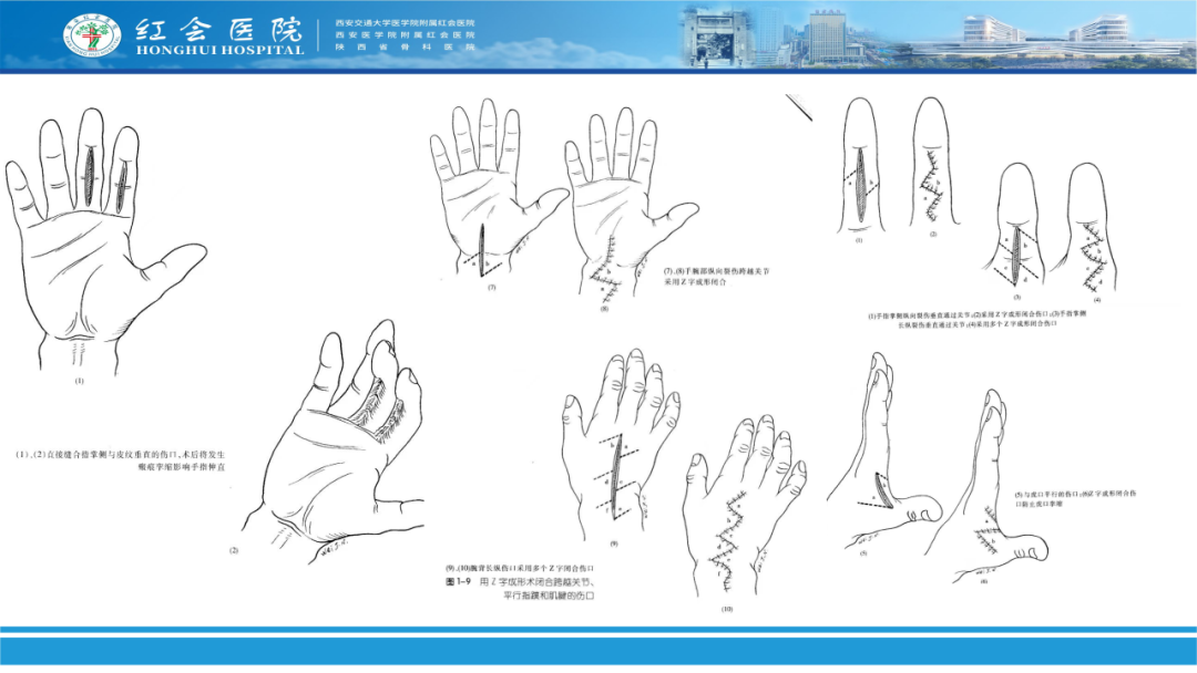 骨科实战：手外伤急诊处理原则精要