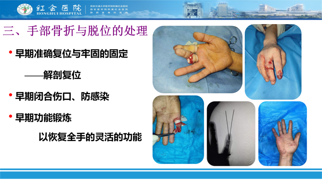 骨科实战：手外伤急诊处理原则精要