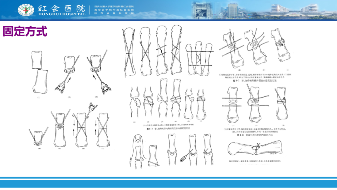 骨科实战：手外伤急诊处理原则精要