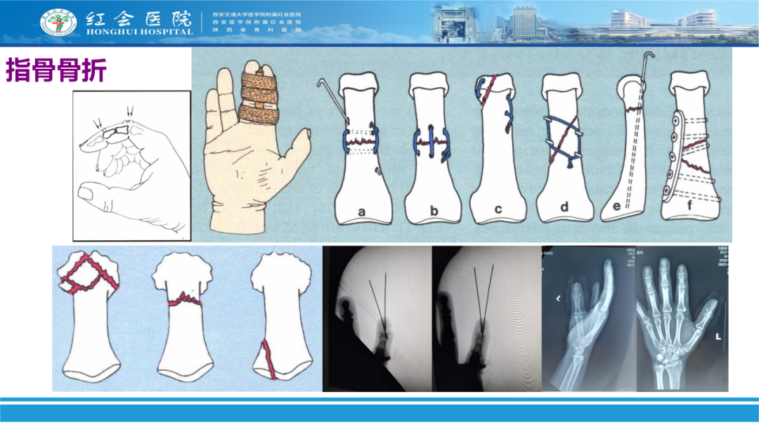 骨科实战：手外伤急诊处理原则精要