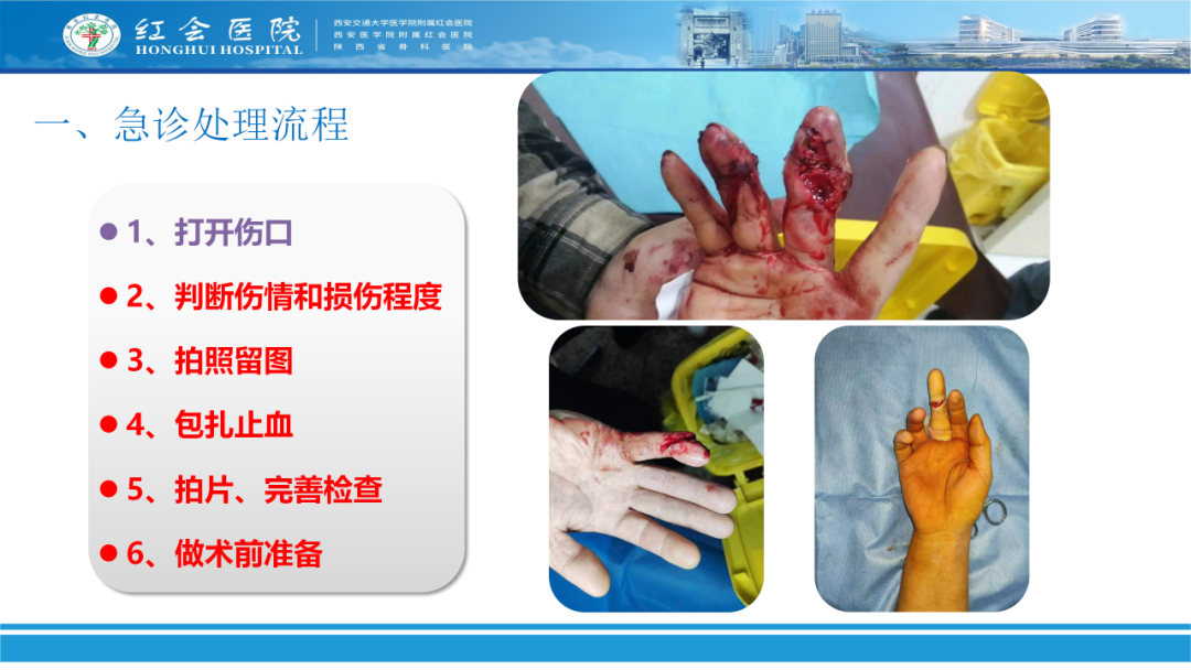 骨科实战：手外伤急诊处理原则精要