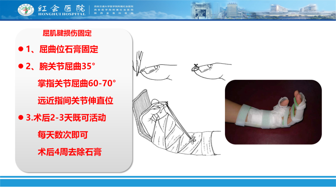 骨科实战：手外伤急诊处理原则精要