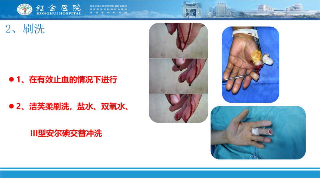 骨科实战：手外伤急诊处理原则精要