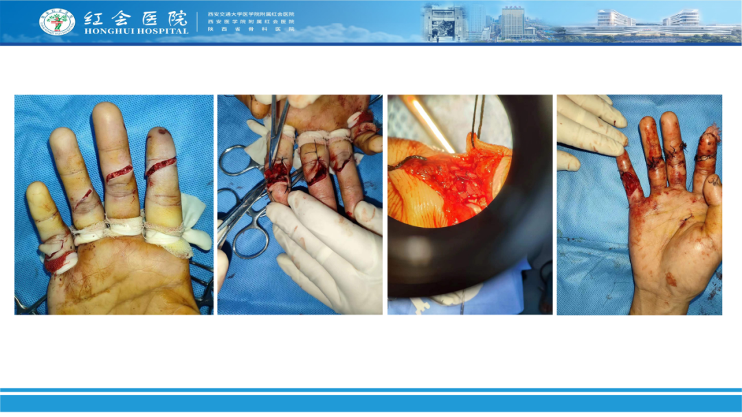 骨科实战：手外伤急诊处理原则精要