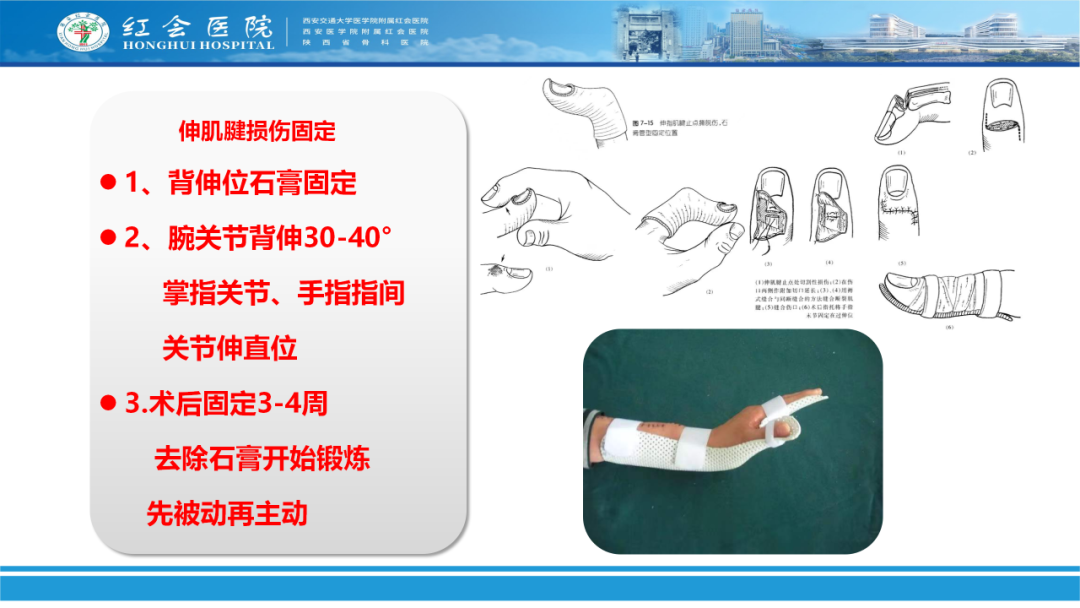 骨科实战：手外伤急诊处理原则精要