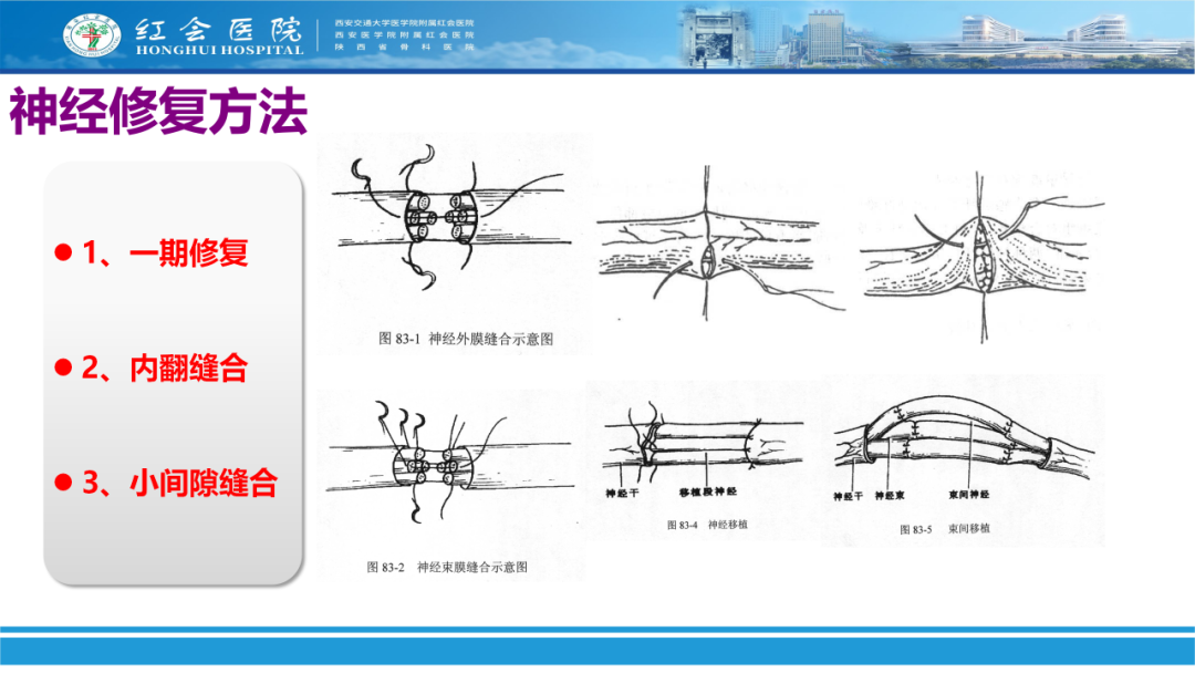 骨科实战：手外伤急诊处理原则精要