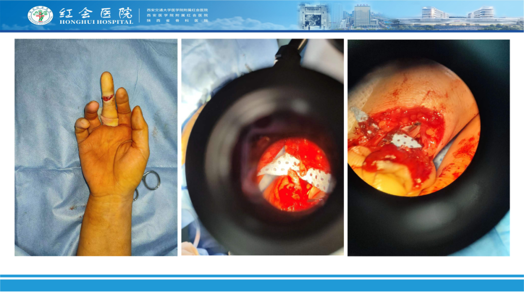 骨科实战：手外伤急诊处理原则精要